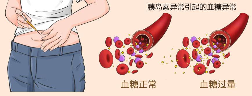 胰岛素抵抗是引起女性不孕症的因素之一
