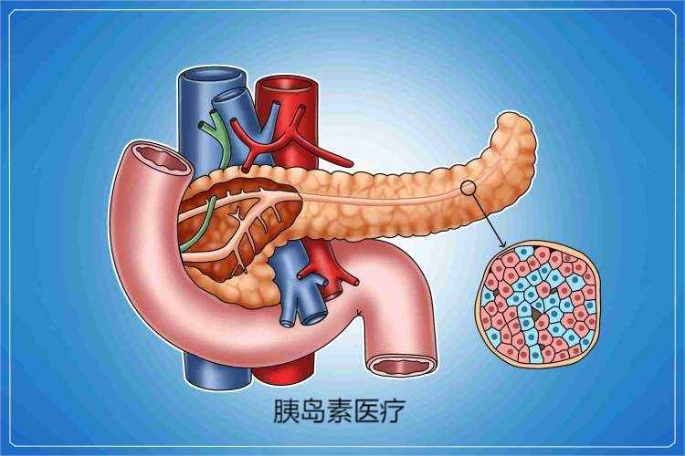 如何检查胰岛素抵抗